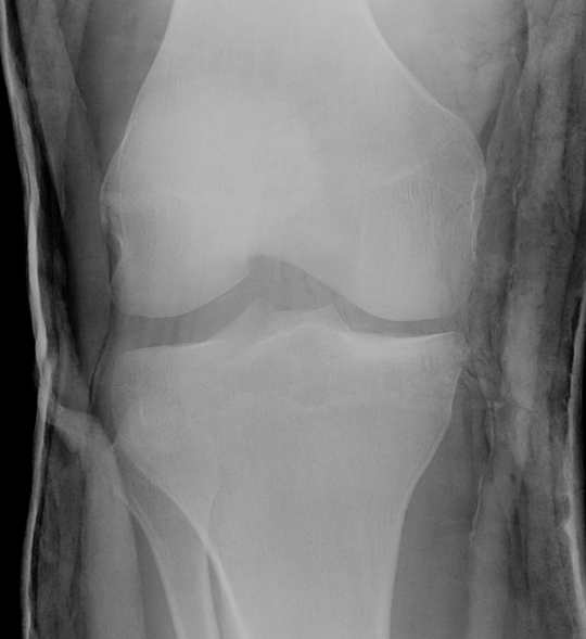 Knee PLC Xray Lateral Widening